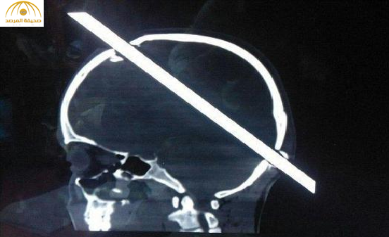 بالصور:سيخ يخترق جمجمة عامل هندي