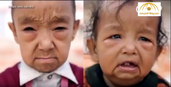 بالصور و الفيديو: طفلان يعانيان من حالة نادرة تجعلهما يشيخان بسرعة