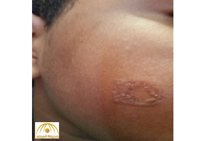 بالصور: معلمة تحرق أطفال في مناطق حساسة بأجسامهم في الرياض