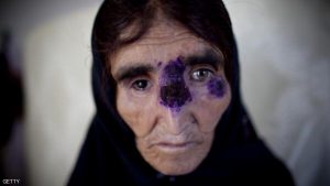 KABUL, AFGHANISTAN - MAY 15: An Afghan recieves treatment for a tropical skin disease at a clinic on May 15, 2010 south of Kabul, Afghanistan. The Afghan capital, Kabul, has one of the highest concentrations of the disfiguring skin disease, Cutaneous leishmaniasis, which is a parasitic disease transmitted by the phlebotomine sand fly. The World Health Organization estimated the number of cases in Kabul jumped from 17,000 in early 2000 to around 65,000 in 2009; the disease is non-lifethreatening and treatable with medication. (Photo by Majid Saeedi/Getty Images)