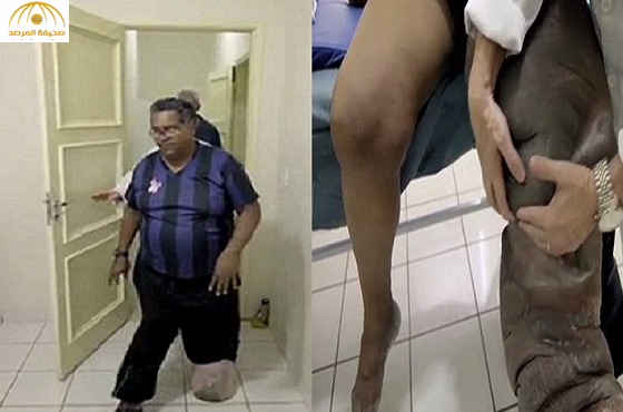 بالفيديو والصور: برازيلي مصاب بمرض نادر يحوله إلى "فيل"