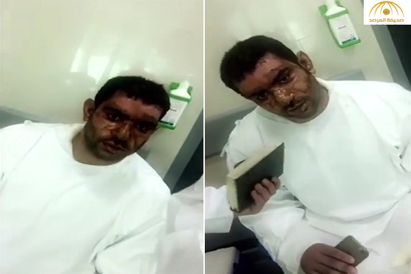 بالفيديو: انفجار شاحن في وجه شاب كويتي أثناء نومه
