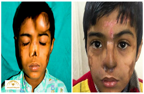بالصور: طفل هندي يفقد أنفه وطبيب يزرع له أنف جديد في جبهته
