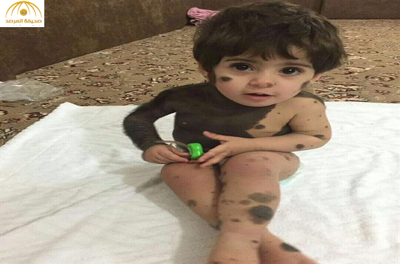 بالصور:طفلة تعاني مرضاً نادراً شوّه جسدها تثير موقع "تويتر"