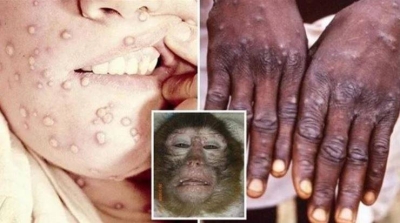 The World Health Organization announces new developments regarding monkeypox… and reveals a good thing about the disease
