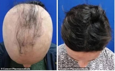 Good news.. the discovery of a new drug to treat baldness that completely restores hair growth on the head within 6 months, and the date of its launch in the market has been revealed