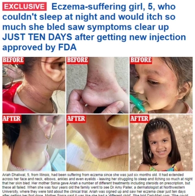 The US Food and Drug Administration approves a new treatment for eczema within only 10 days..and reveal its price