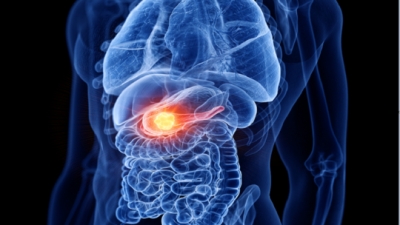Detecting the most common signs of pancreatic cancer in its early stages