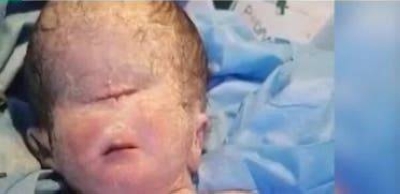 “Rare and Tragic: One-Eyed Baby Born in Dhi Qar Hospital, Causes and Explanation”