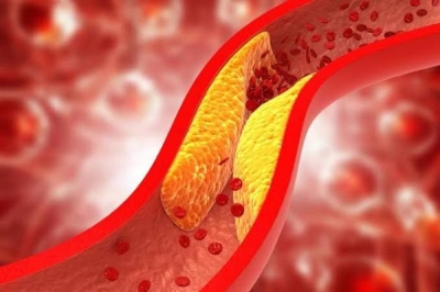 “Warning Signs of Cholesterol Buildup and PAD: Night Sensations, Pain, and Diet Tips”