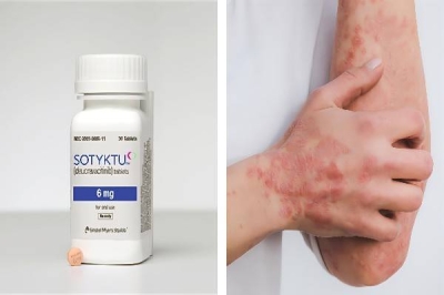 The British Medicines Agency Approves Diocravacatinib: A Breakthrough Treatment for Psoriasis
