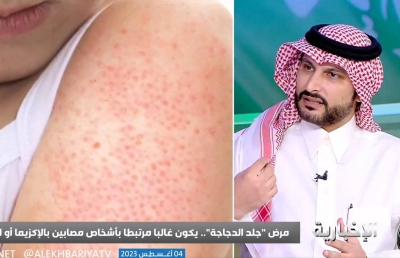 Prevalence and Causes of ‘Chicken Skin’ Disease in Women and Children: Insights from Dermatology Consultant Dr. Ali Al-Omari