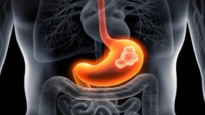 Recognizing the Early Signs and Symptoms of Stomach Cancer