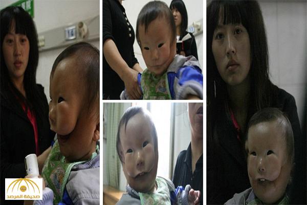 بالصور: مأساة الطفل الصيني "ذو القناع" تثير تعاطف الملايين حول العالم