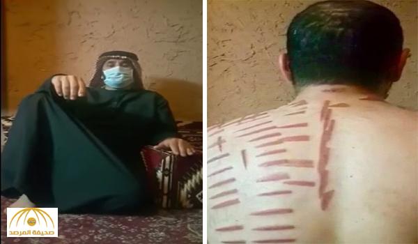 بالفيديو.. مواطن يكشف واقعة "كيّه" بالأسياخ في رأسه وظهره بالقصيم