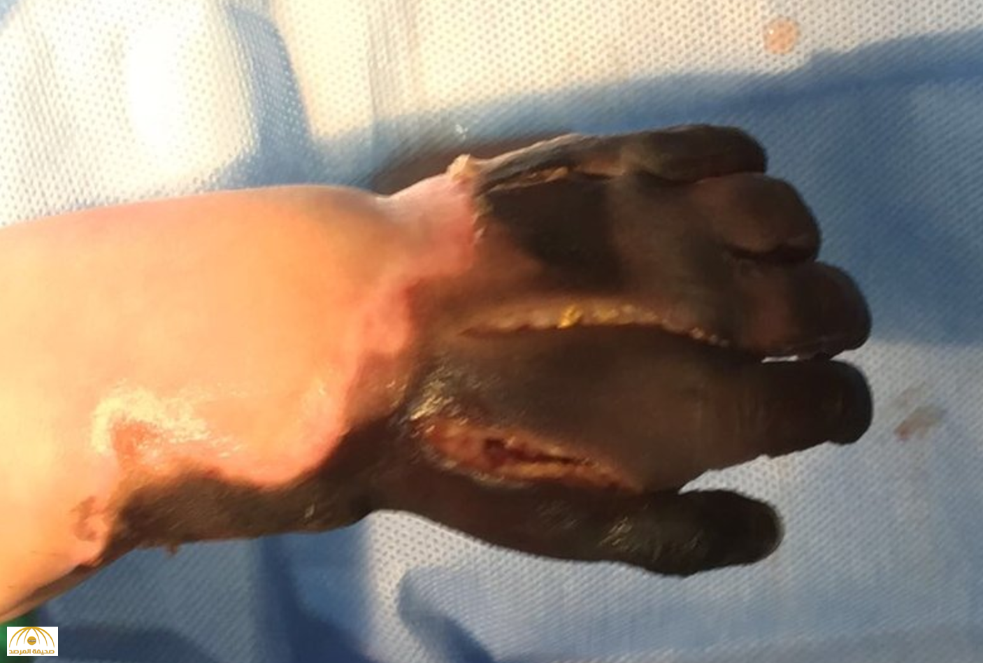 تطور مأساوي حول يد الطفل "جسار السلمي"بعد تحولها للون الأسود ..والأطباء يقررون "البتر"-صور