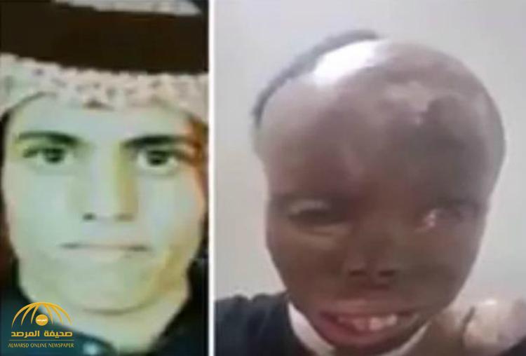 هكذا تفاعل  الأمير" محمد بن سلمان"مع مواطن مصاب بتشوهات نتيجة لحروق خطيرة في وجهه!