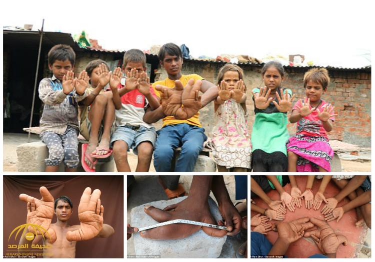 بالصور و الفيديو : حالة مرضية نادرة تحول الصبي طارق إلى "الشيطان" في الهند