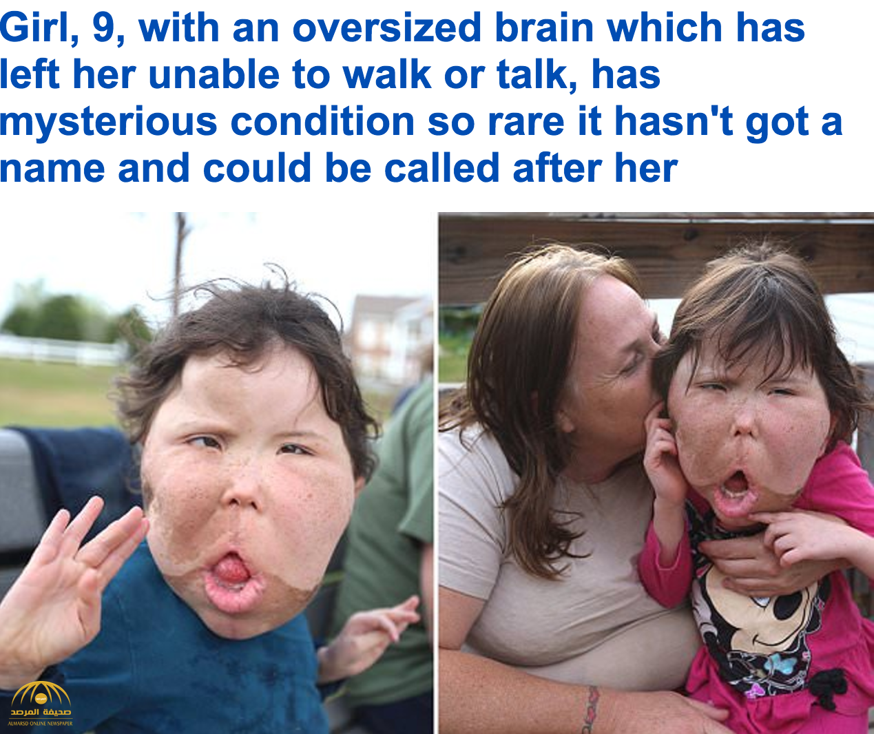 شاهد بالفيديو والصور: مأساة طفلة تعاني من أغرب حالة "تضخم دماغ" في العالم!