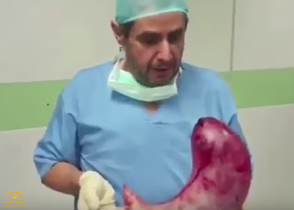بالفيديو : طبيب يحمل معدة بشرية ضخمة ويكشف سر نمو حجمها  بهذا الشكل!