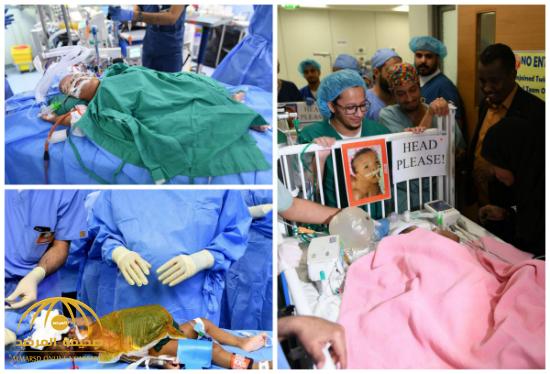 بعد عملية استمرت 9 ساعات .. مستشفى الملك عبدالله التخصصي بالرياض يعلن نجاح فصل التوأم السوداني الملتصق - صور