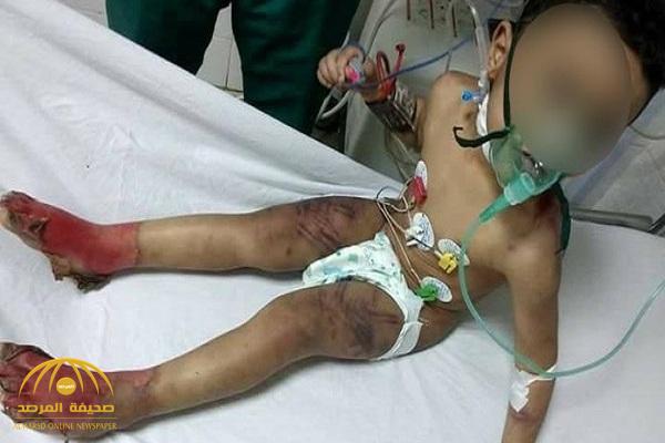 واقعة صادمة.. بالصور: سيدة تعذب طفلها وتصيبه بحروق خطيرة في مصر