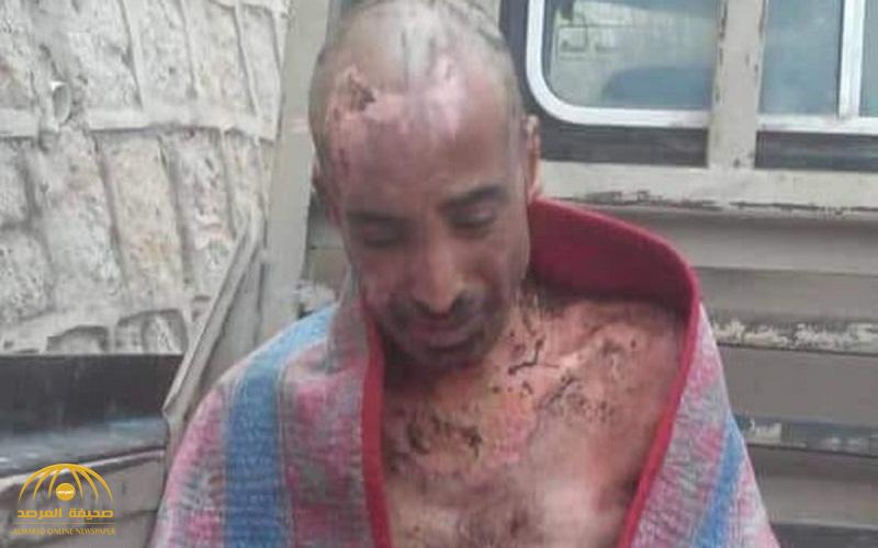 صور صادمة لدكتور يمني تم تعذيبه على يد المليشيات الحوثية المدعومة من إيران
