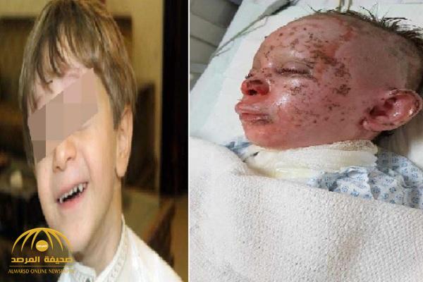 أول تعليق من "الكهرباء" على إصابة الطفل "عبدالرحمن" نتيجة صعق كهربائي!