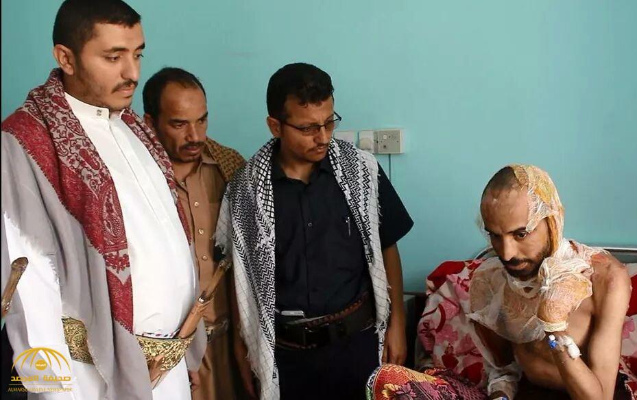 بعد تعذيب ميليشيا الحوثي لشاب يمني وحرق جسده بالكامل.. بالفيديو: طبيب يدلي بشهادته: هذا ما تعرض له "منير"