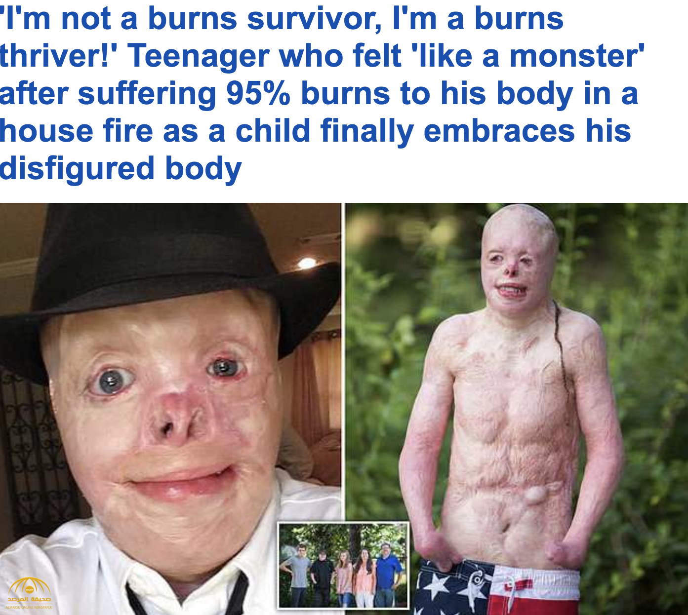 بالصور والفيديو : قصة شاب أمريكي احترق 95% من جسده