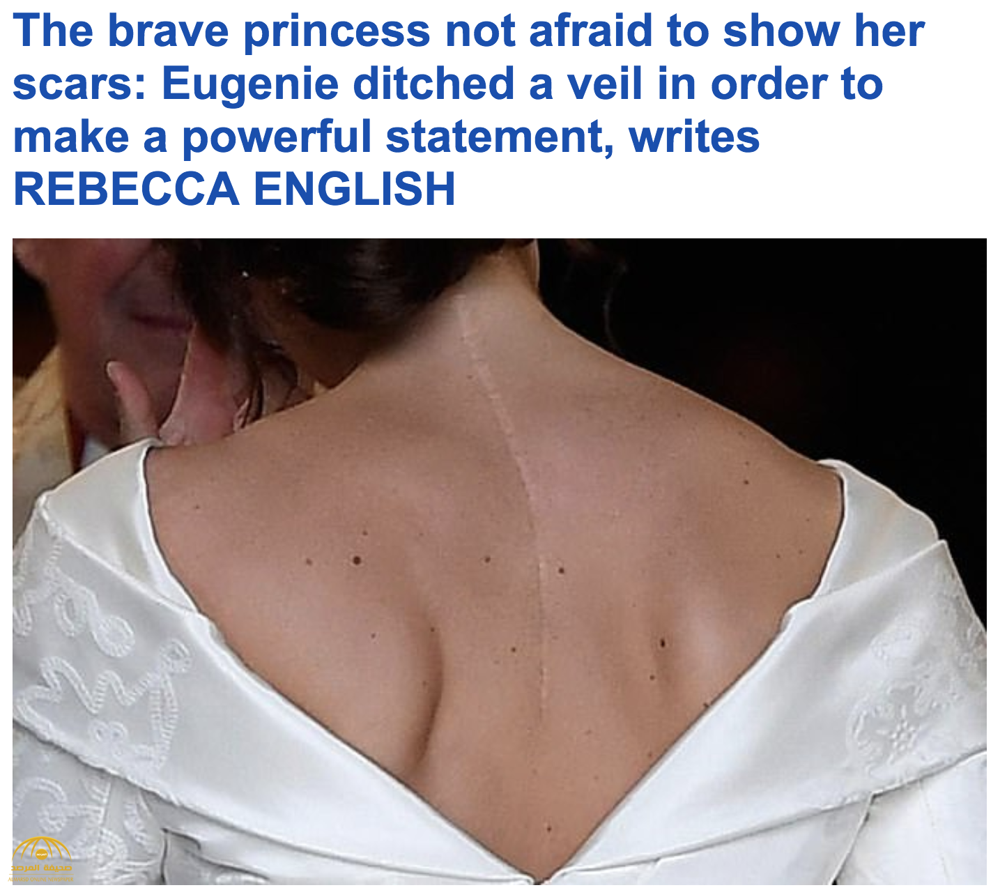 بالصور : السر وراء إصابة حفيدة ملكة بريطانيا بجرح "عميق" في الظهر الذي كشف عنه فستان زفافها!