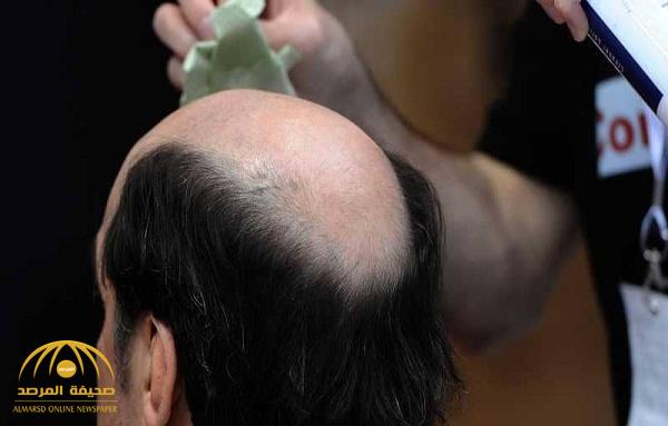 وداعاً لصلع الشعر .. علماء يكتشفون علاجاً لحل المشكلة التي تؤرق الملايين!