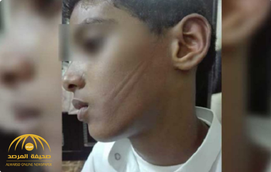 معلم يعاقب طالب بضربه بسلك كهربائي على وجهه في مدرسة بصامطة.. وهذا ما فعله والده!