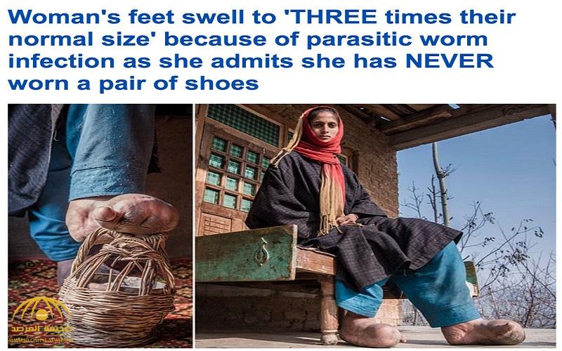 ترجمة حصرية .. شاهد : قدم امرأة هندية تتضخم لثلاثة أضعاف حجمها وهذا ما كشفته عن حالتها
