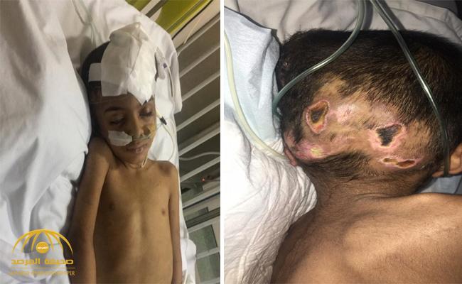 مواطن ينشر صور بشعة  لأثار التعذيب على جسد طفل بخميس مشيط .. ويكشف عن هوية الجاني