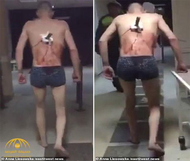 شاهد: شاب روسي يخرج من المستشفى بسكين في ظهره  من أجل تدخين سيجارة !