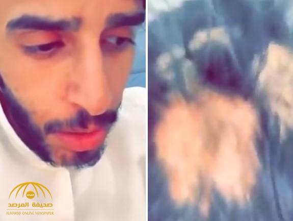 شاهد: شاب سعودي يوثق إصابته بالصلع في الذقن والرأس بسبب "العين" ويوجه نصيحة!