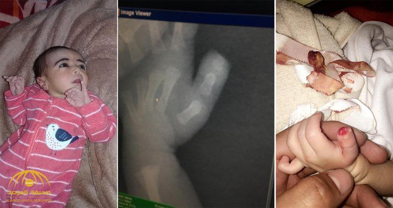 حادثة غريبة.. بتر غامض في إصبع مولودة بعد إدخالها مستشفى "أحد رفيدة".. والممرضة: كانت ترضع وقطعته (صورة)