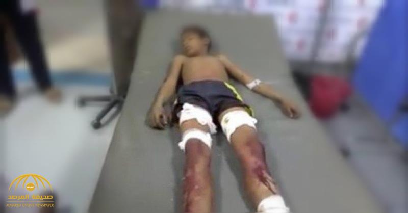 مقتل وإصابة طفلين شقيقين في انفجار مقذوف حوثي!