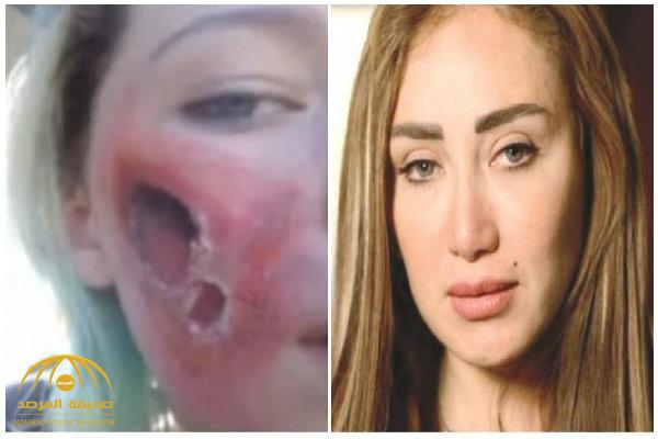 بالفيديو.. طبيبة جلدية تكشف معلومات صادمة عن مرض الإعلامية  "ريهام سعيد"