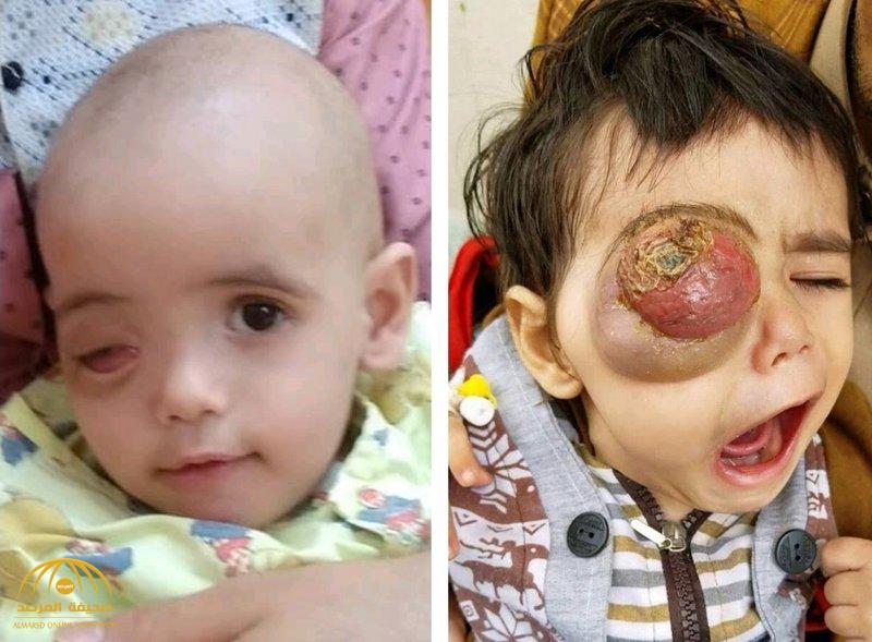 أُصيب بورم خبيث جعل شكل عينه مرعبًا.. شاهد: هكذا أصبح الطفل اليمني "رواف" بعد علاجه على نفقة ولي العهد