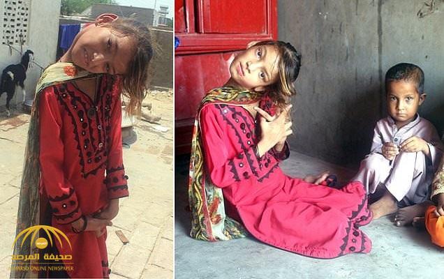 شاهد : فتاة باكستانية تعيش برقبة غريبة !