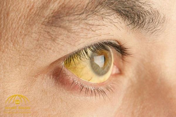 "اصفرار العين".. مؤشر للإصابة بأمراض خطيرة
