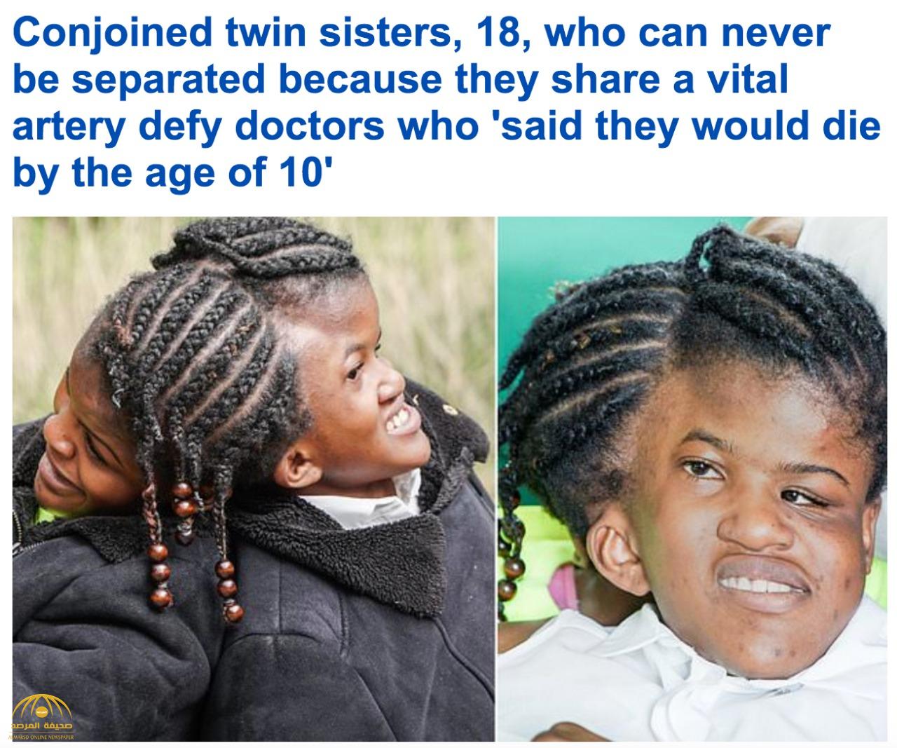 لله في خلقه شؤون.. شاهد: فتاتان ملتصقتان عند منطقة الرأس.. وهذا ما أكده الأطباء بشأن حالتيهما!