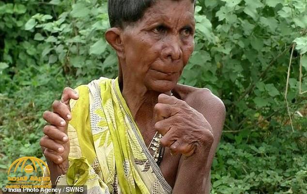 "لُقبت بالساحرة".. شاهد : امرأة هندية تُولد بـ31 إصبعًا..وهكذا يعاملها جيرانها !