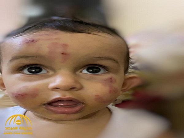 آثار دماء وجروح على وجهه.. شاهد: تعنيف طفل في حضانة مدرسة بالعيدابي.. ووالده يعلق !