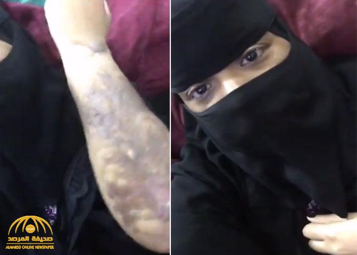 شاهد .. مواطنة تشكي تعرضها للتعنيف من عمها وحرق جسدها بمادة الأسيد