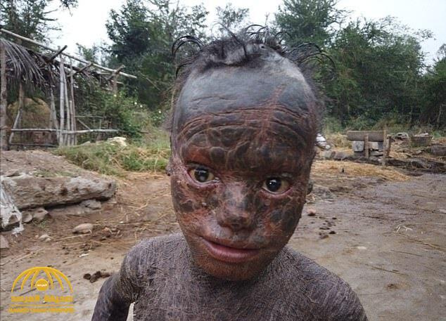 شاهد.. "الطفل الثعبان " يستحم كل ساعة بسبب مرض نادر يغطي جسده بجلد سميك !