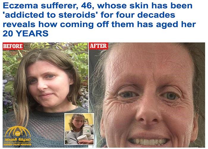 "بعد معاناة استمرت 40 عاما ".. شاهد: سيدة بريطانية تكشف عن علاج سحري لـ"الأكزيما" بقيمة 13 جنيها استرلينيًا