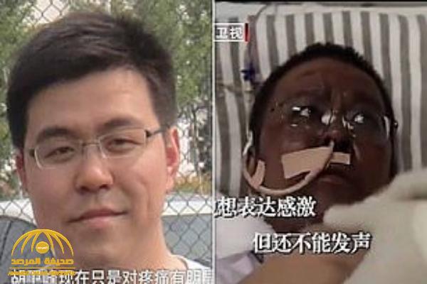 نهاية مأساوية للطبيب الصيني الذي تحولت بشرته للون الداكن  بعد 5 أشهر من محاربة كورونا -صور